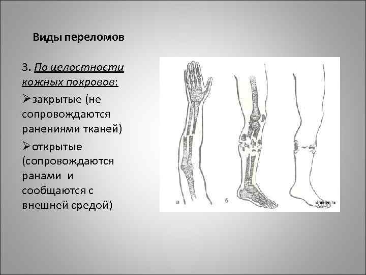 Виды переломов 3. По целостности кожных покровов: Øзакрытые (не сопровождаются ранениями тканей) Øоткрытые (сопровождаются