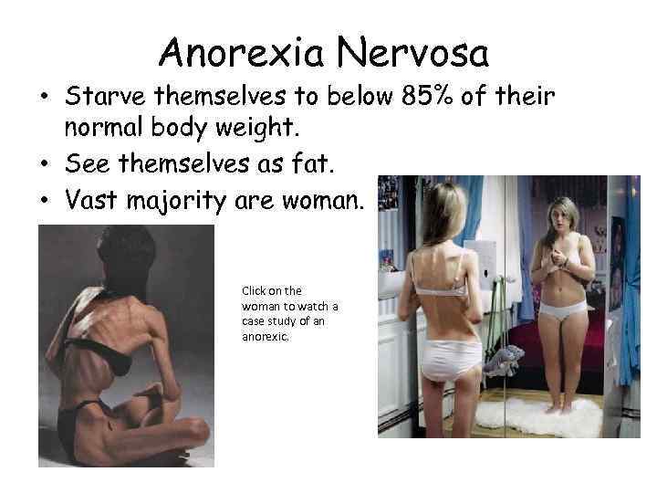 Anorexia Nervosa • Starve themselves to below 85% of their normal body weight. •