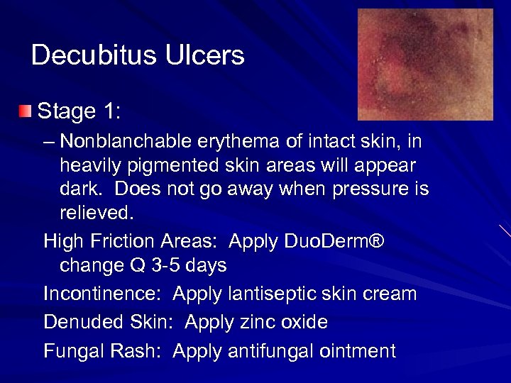 Decubitus Ulcers Stage 1: – Nonblanchable erythema of intact skin, in heavily pigmented skin