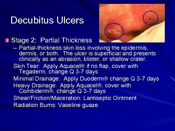 Decubitus Ulcers Stage 2: Partial Thickness – Partial-thickness skin loss involving the epidermis, or