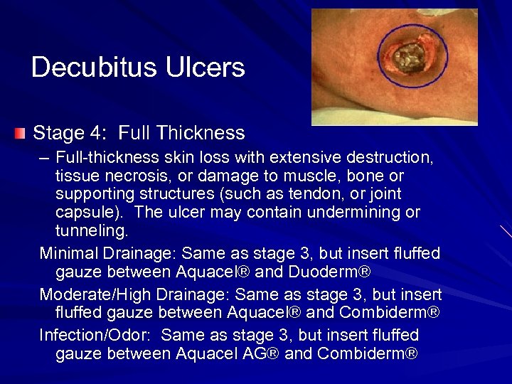 Decubitus Ulcers Stage 4: Full Thickness – Full-thickness skin loss with extensive destruction, tissue