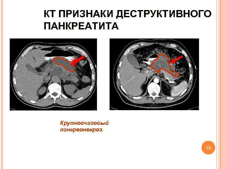 КТ ПРИЗНАКИ ДЕСТРУКТИВНОГО ПАНКРЕАТИТА Крупноочаговый панкреонекроз. 15 