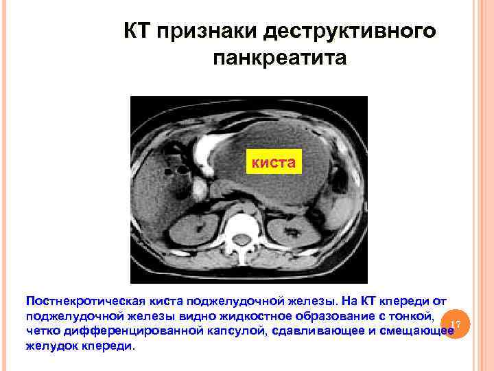 КТ признаки деструктивного панкреатита киста Постнекротическая киста поджелудочной железы. На КТ кпереди от поджелудочной