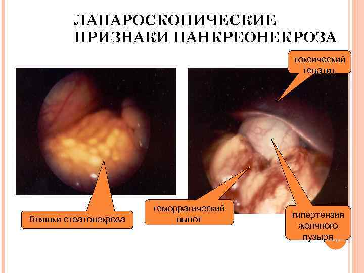 ЛАПАРОСКОПИЧЕСКИЕ ПРИЗНАКИ ПАНКРЕОНЕКРОЗА токсический гепатит бляшки стеатонекроза геморрагический выпот гипертензия желчного пузыря 18 