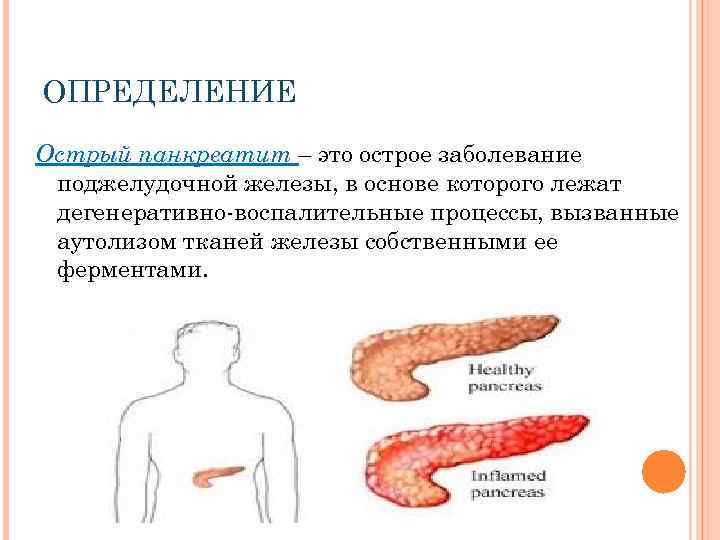 ОПРЕДЕЛЕНИЕ Острый панкреатит – это острое заболевание поджелудочной железы, в основе которого лежат дегенеративно