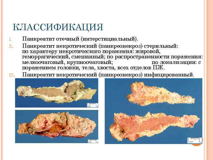 КЛАССИФИКАЦИЯ I. II. III. Панкреатит отечный (интерстициальный). Панкреатит некротический (панкреонекроз) стерильный: по характеру некротического