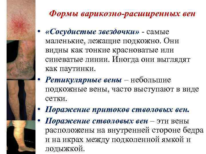 Формы варикозно-расширенных вен • «Сосудистые звездочки» - самые маленькие, лежащие подкожно. Они видны как