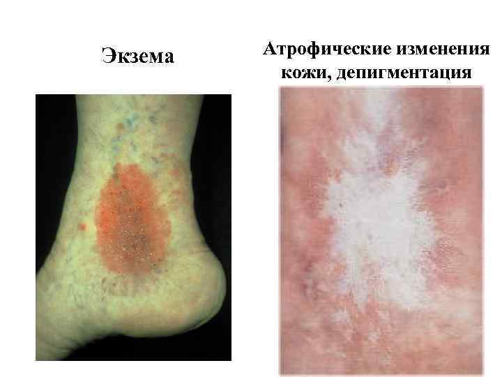 Экзема Атрофические изменения кожи, депигментация 