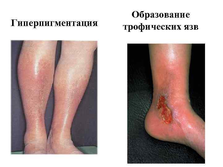 Гиперпигментация Образование трофических язв 