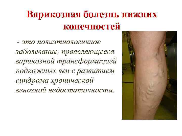 Варикозная болезнь нижних конечностей - это полиэтиологичное заболевание, проявляющееся варикозной трансформацией подкожных вен с