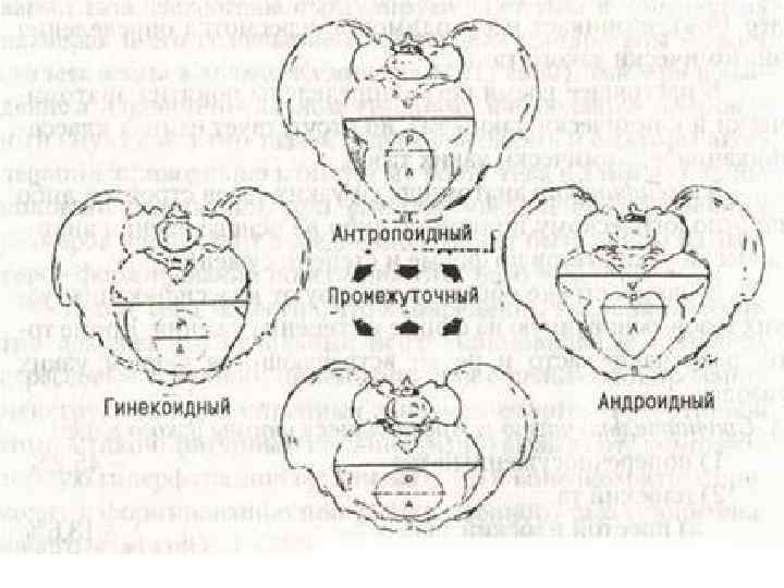 Гинекоидный таз. Классификация по форме сужения таза. Узкий таз классификация узких тазов по форме и степени сужения. Гинекоидный Тип таза. Сужение таза по степеням.