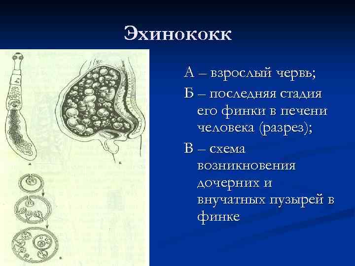 Эхинококк А – взрослый червь; Б – последняя стадия его финки в печени человека