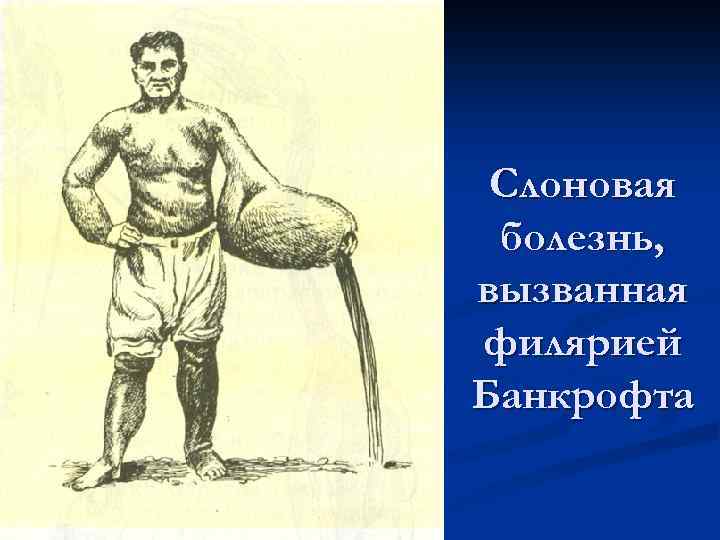 Слоновая болезнь, вызванная филярией Банкрофта 