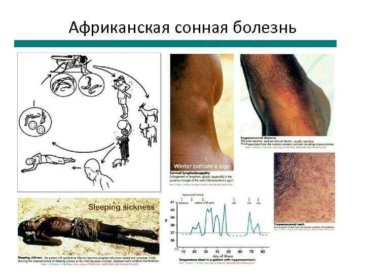 Африканская сонная болезнь 