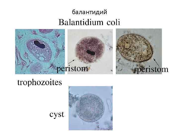 балантидий 