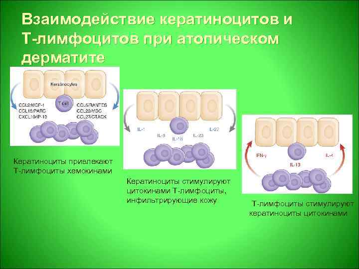 Взаимодействие кератиноцитов и Т-лимфоцитов при атопическом дерматите Кератиноциты привлекают Т-лимфоциты хемокинами Кератиноциты стимулируют цитокинами