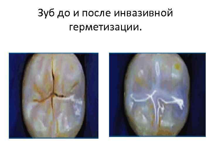 Зуб до и после инвазивной герметизации. 