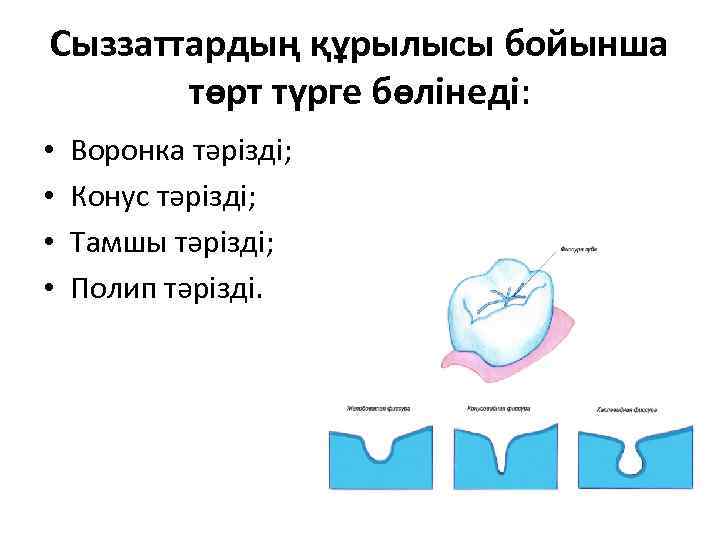 Сыззаттардың құрылысы бойынша төрт түрге бөлінеді: • • Воронка тәрізді; Конус тәрізді; Тамшы тәрізді;