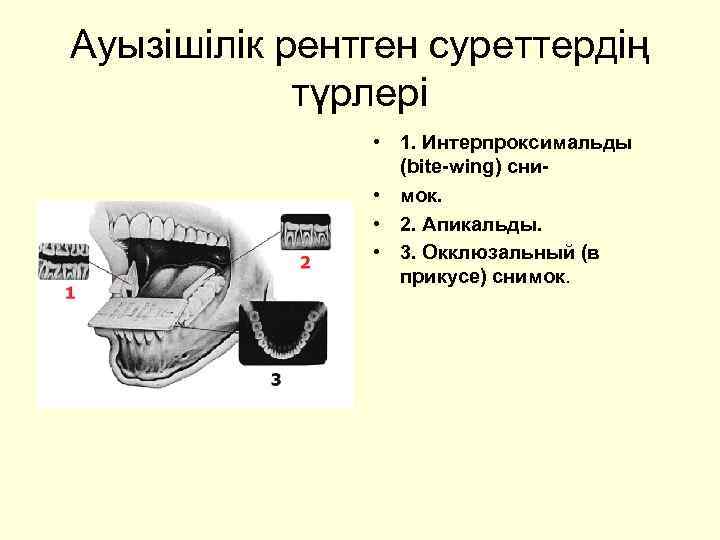 Ауызішілік рентген суреттердің түрлері • 1. Интерпроксимальды (bite-wing) сни • мок. • 2. Апикальды.