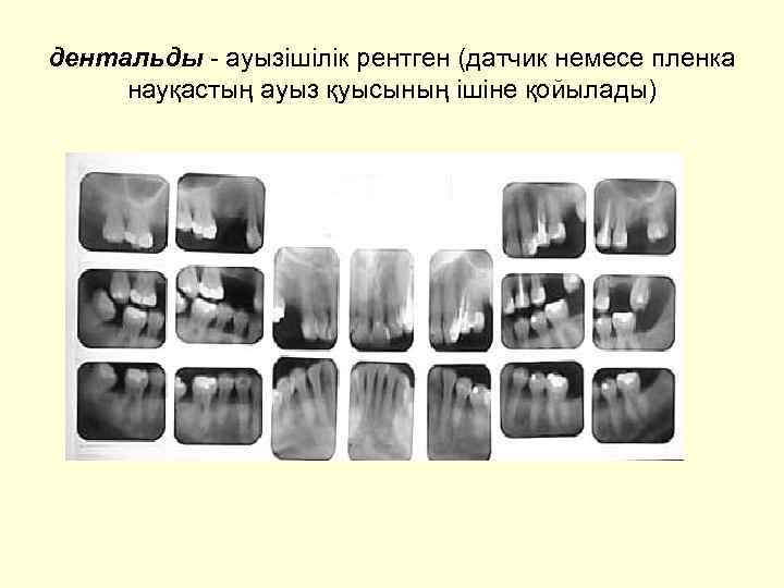 дентальды - ауызішілік рентген (датчик немесе пленка науқастың ауыз қуысының ішіне қойылады) 