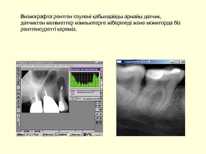 Визиографта рентген сәулені қабылдайды арнайы датчик, датчиктен мәліметтер компьютерге жіберіледі және мониторда біз рентгенсуретті