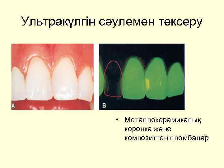 Ультракүлгін сәулемен тексеру • Металлокерамикалық коронка және композиттен пломбалар 