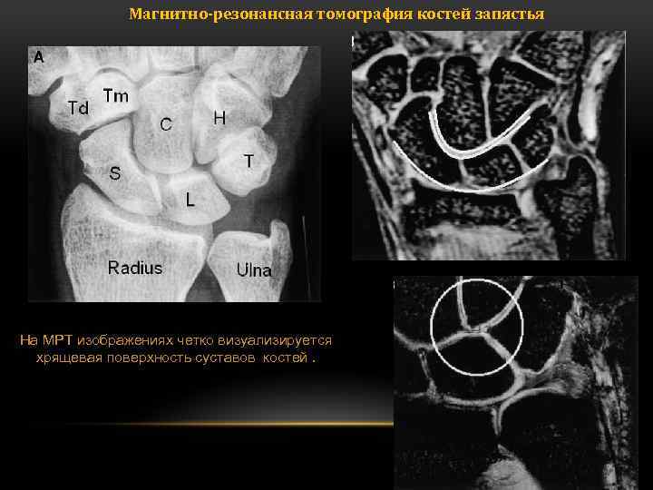 Магнитно-резонансная томография костей запястья На МРТ изображениях четко визуализируется хрящевая поверхность суставов костей. 