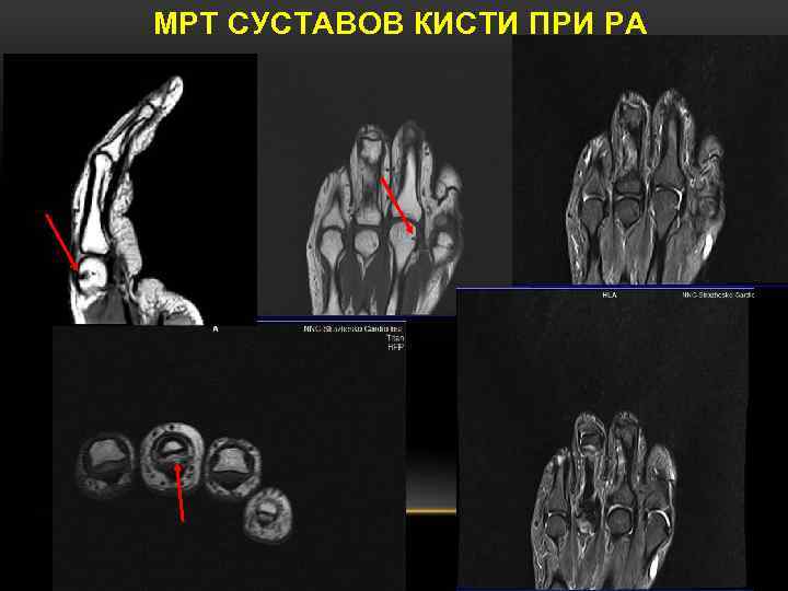 Мрт кисти. Мрт суставов одной кисти.