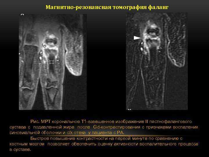 Магнитно-резонансная томография фаланг Рис. МРТ корональное T 1 -взвешенное изображение ІІ пястнофалангового сустава с