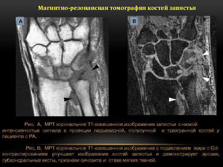 Болезнь кинбека презентация