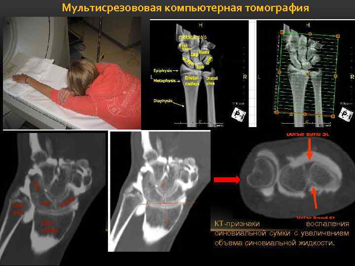Мультисрезововая компьютерная томография КТ-признаки воспаления синовиальной сумки с увеличением объема синовиальной жидкости. 
