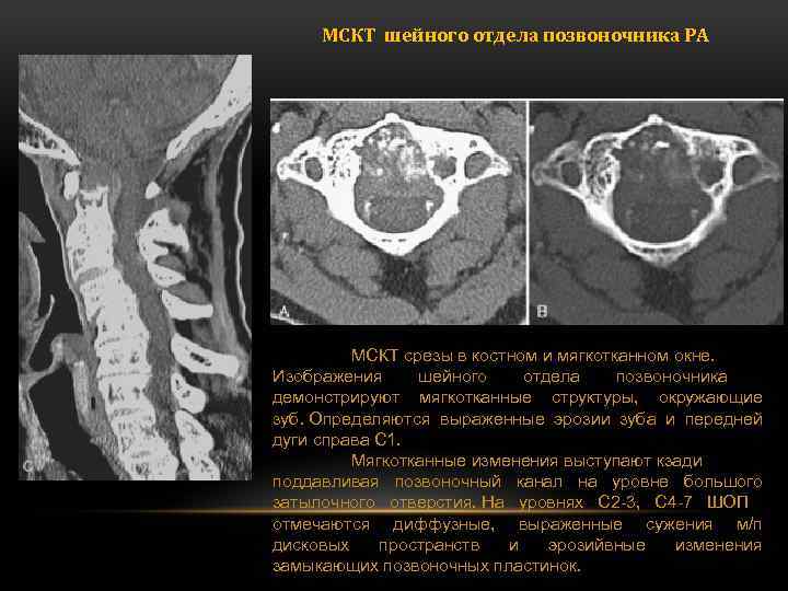 МСКТ шейного отдела позвоночника РА МСКТ срезы в костном и мягкотканном окне. Изображения шейного