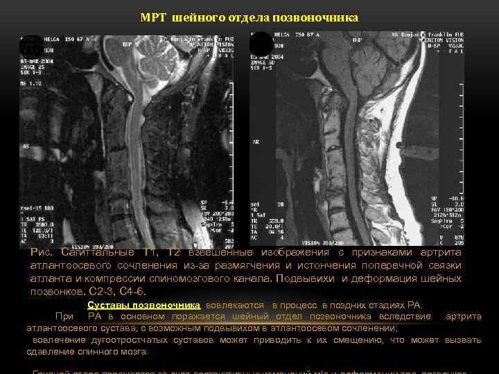 Снимки мрт шейного отдела позвоночника фото расшифровка