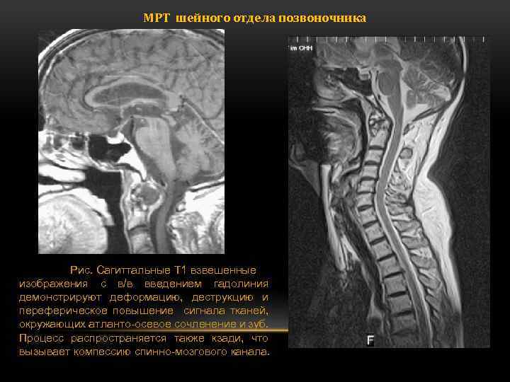 Мрт шейного. Мрт шейного отдела норма. Мрт шейного отдела позвоночника патологии. Аномалия шейного отдела позвоночника мрт. Мрт шейного отдела позвоночника заболевания.