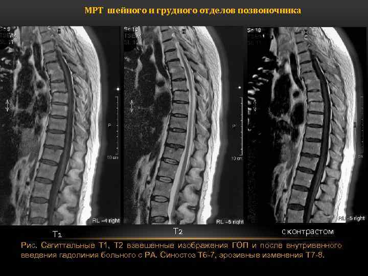 Мрт грудного позвоночника. Ревматоидный артрит позвоночника мрт. Мрт грудного отдела позвоночника Аксиал.