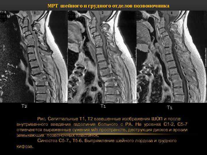 Мрт 2. Т1 и т2 мрт шейного отдела позвоночника что это. Мрт позвоночника т1 т2 режимы. T1 t2 режимы мрт. Кифоз грудного отдела мрт.