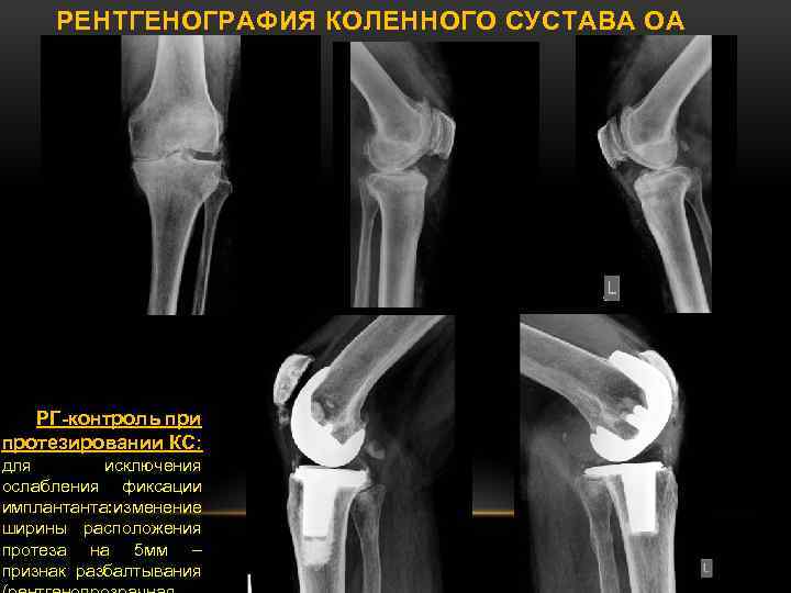 Лигаментоз крестообразных связок коленных. Дисторсия коленного сустава рентген. Лигаментоз коленного сустава рентген. Рентген снимки коленного сустава норма. Что такое КТИ на рентгене коленного сустава.