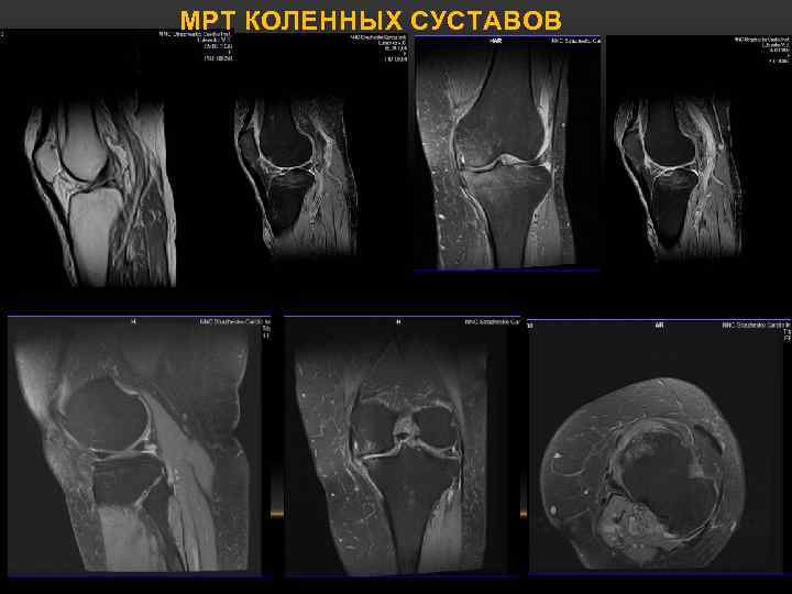 Мрт суставов спб. Bursa iliotibialis мрт коленного сустава. Мрт коленного сустава норма. Мрт коленного сустава Dicom.