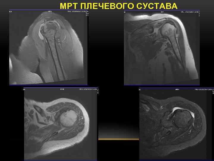 Мрт плечевого. Вывих плечевого сустава мрт. Мрт срезы плечевого сустава.