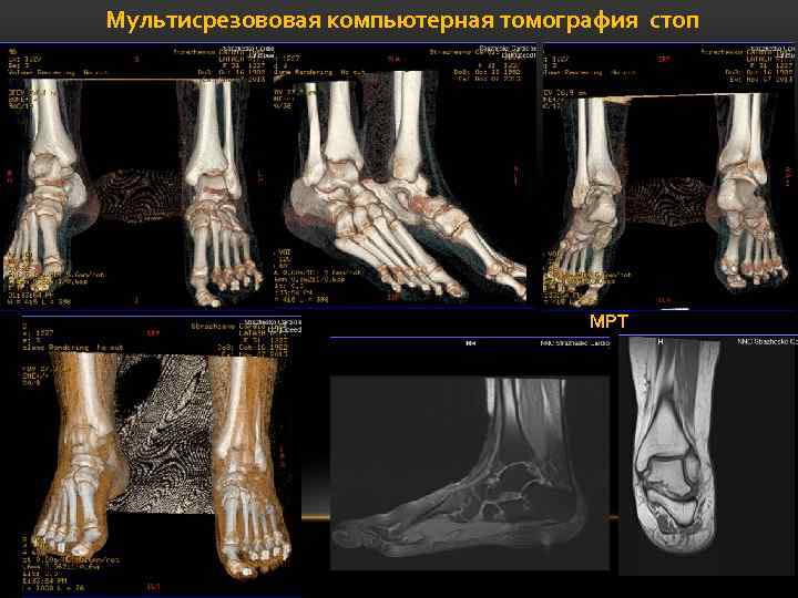 Мультисрезововая компьютерная томография стоп МРТ 