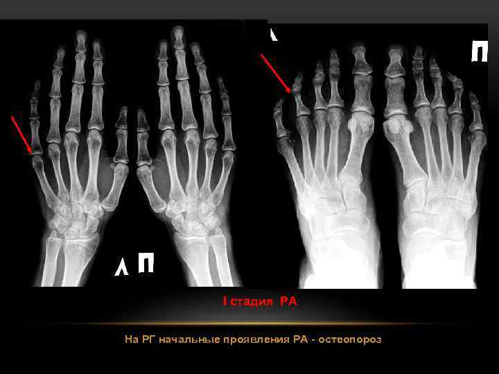 I стадия РА На РГ начальные проявления РА - остеопороз 