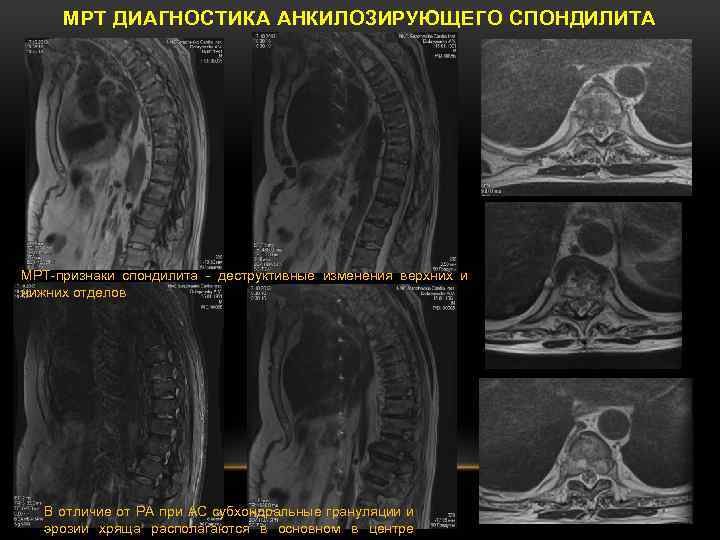 Какую картину дает мрт при болезни бехтерева