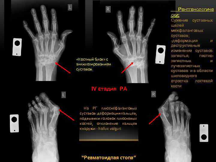  Рентгенологиче ски: «Костный блок» с анкилозированием суставов. IV стадия РА На РГ плюснефаланговых