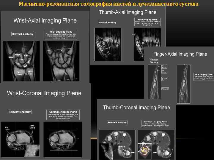 Магнитно-резонансная томография кистей и лучезапястного сустава 