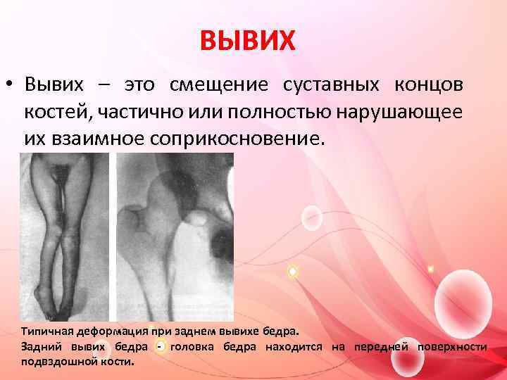 ВЫВИХ • Вывих – это смещение суставных концов костей, частично или полностью нарушающее их