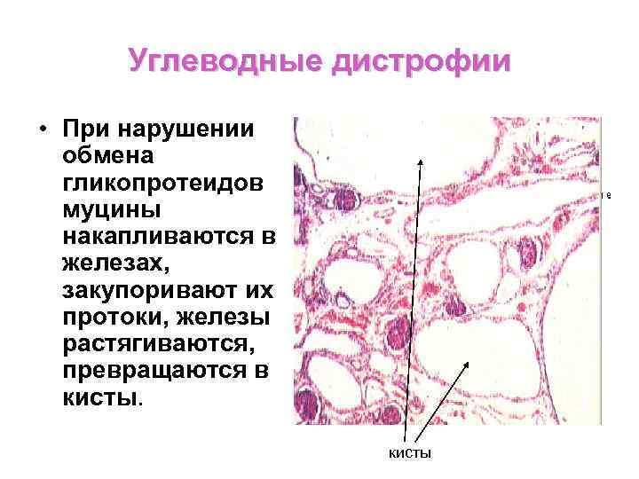 Углеводные дистрофии презентация