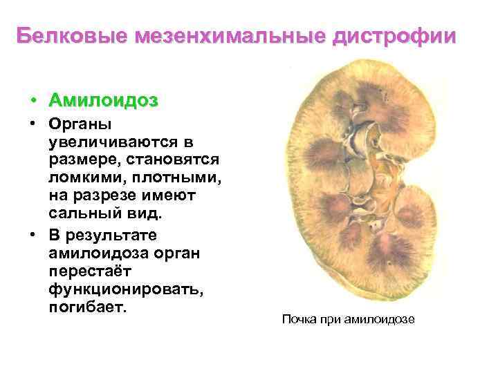 Белковые дистрофии схема