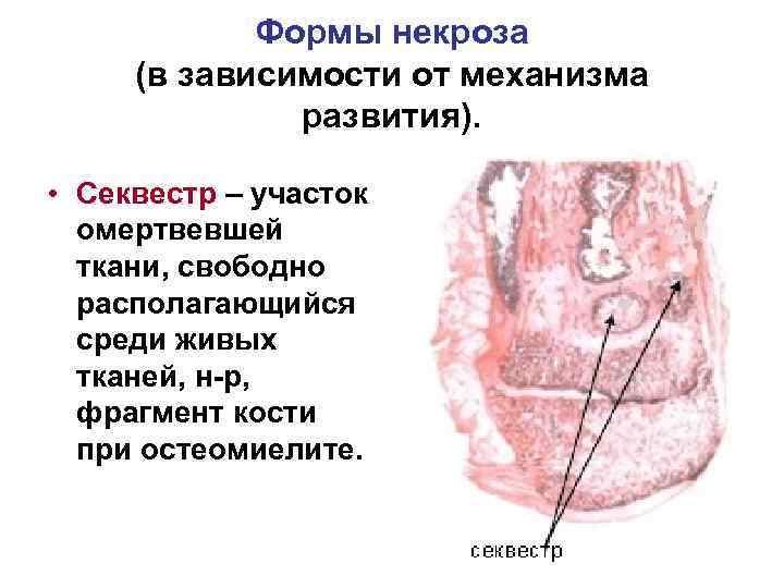 Формы некроза презентация