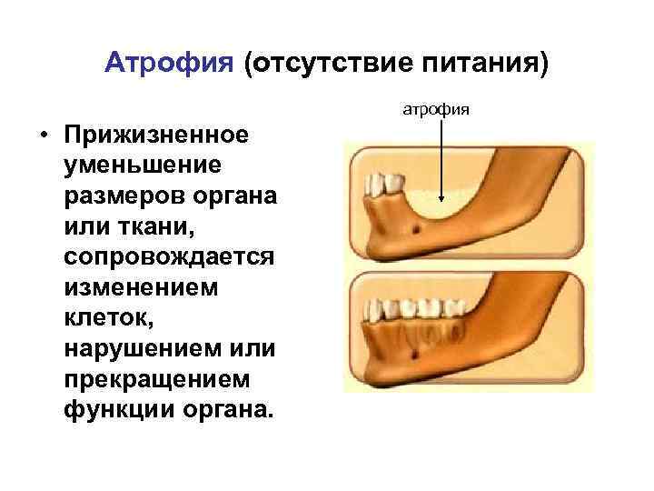 Атрофия презентация патология