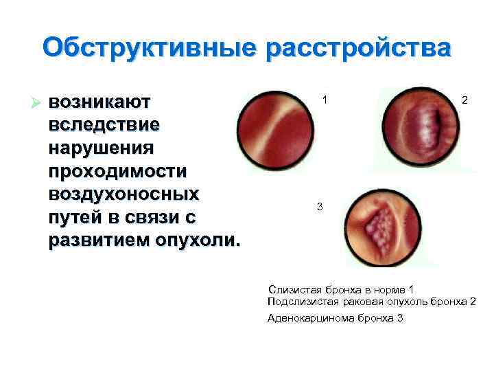 Обструктивные расстройства Ø возникают вследствие нарушения проходимости воздухоносных путей в связи с развитием опухоли.